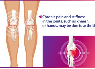 Illustration of arthritis affecting knee joints